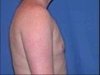 Breast Reduction for Men: Great value, Great results