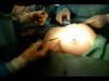 Mamoplasty by Dr Ardeshir VAHIDI 0001